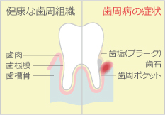 歯周病
