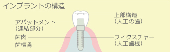 インプラントの仕組み